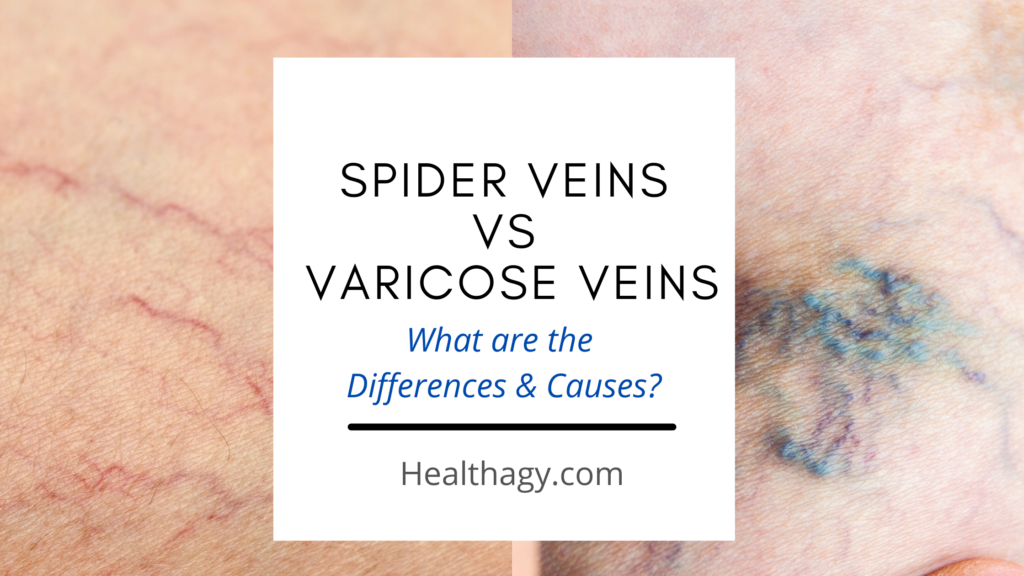 Spider Veins Vs Varicose Veins What Are The Differences And Causes Healthagy 5870